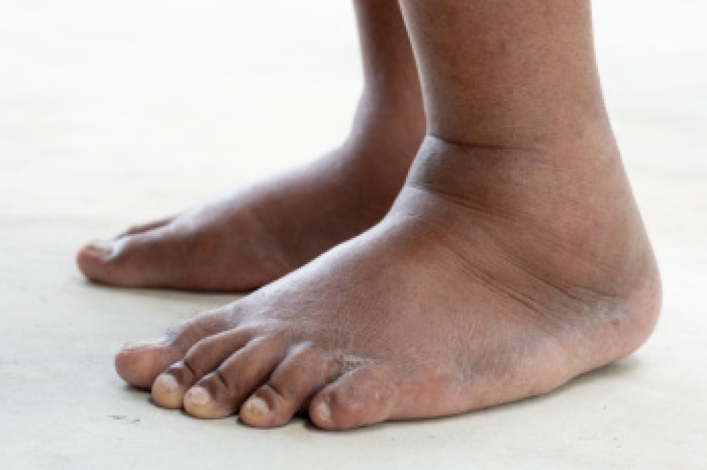 Causes and Treatment of Swollen Feet