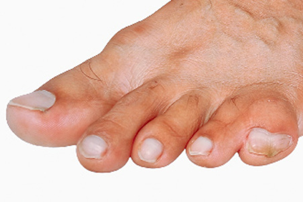 Webbed Toes and How They Affect Foot Function