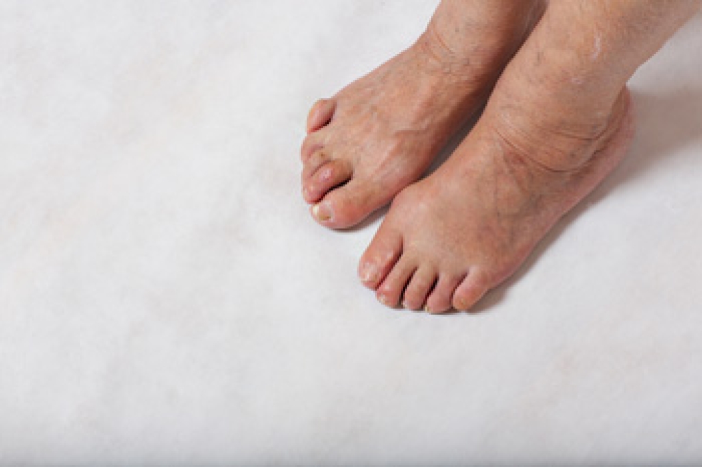 Causes and Treatment of Hammertoe
