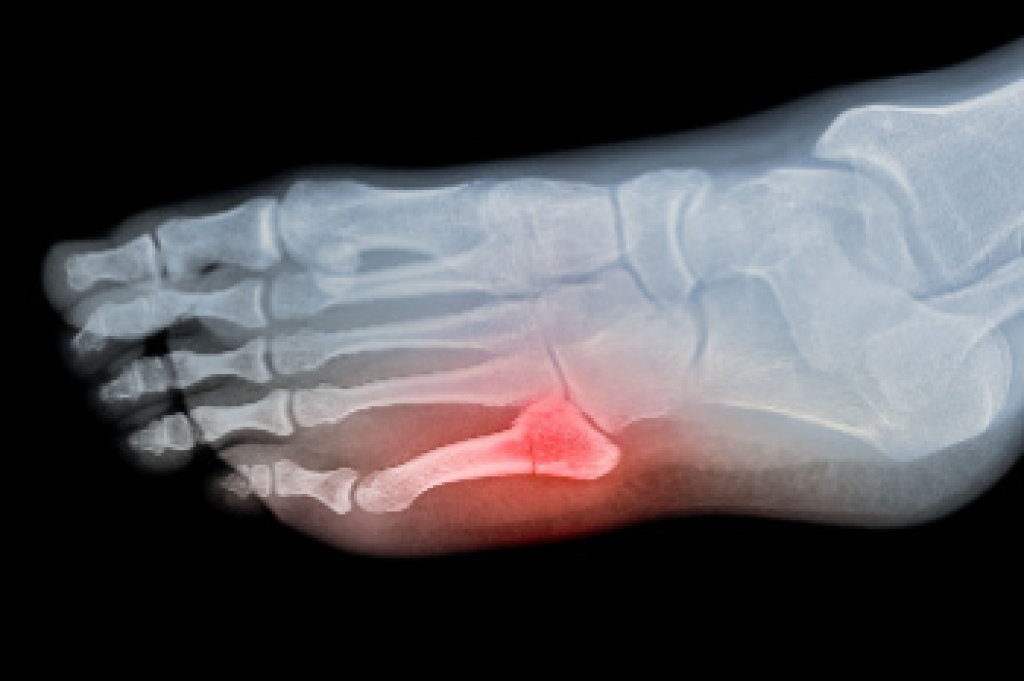 Signs and Causes of a Broken Pinky Toe