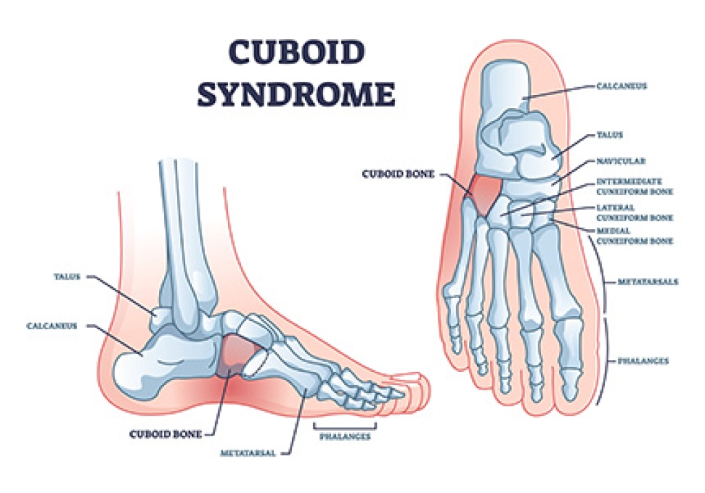 Signs of Cuboid Syndrome