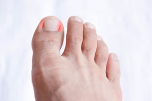 Signs You May Have an Ingrown Toenail