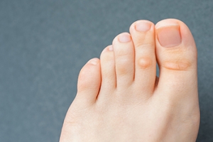 An Overview of Corns and Foot Health