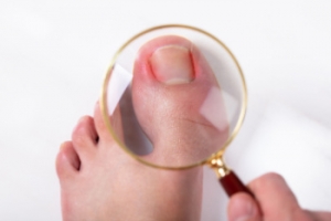 Risk Factors and Causes of Ingrown Toenails