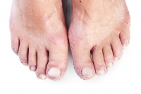 How Psoriasis Can Affect the Feet