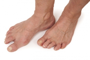 How Rheumatoid Arthritis Can Impact Your Toes