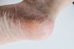 How a Podiatrist Can Help Cracked Heels