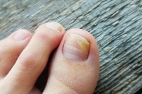 Definition and Causes of Toenail Fungus