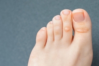 What Causes Corns on the Feet?