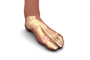 Causes of Gout