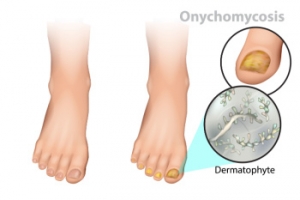 Treatment Choices for Toenail Fungus