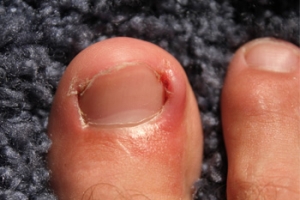 What is an Ingrown Toenail?