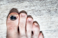 How Running Can Affect Your Toenails