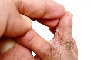 Athlete&rsquo;s Foot and How It Differs from Eczema