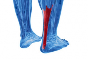 Facts About Achilles Tendon Pain